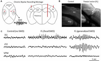 Cortical Layer and Spectrotemporal Architecture of Epileptiform Activity in vivo in a Mouse Model of Focal Cortical Malformation